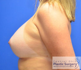 Breast Augmentation