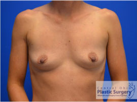 Breast Augmentation