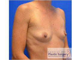 Breast Augmentation