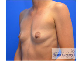 Breast Augmentation