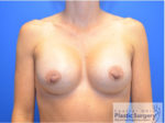 Breast Augmentation