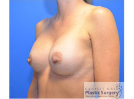 Breast Augmentation