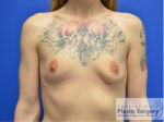 Breast Augmentation