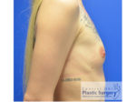 Breast Augmentation