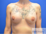 Breast Augmentation