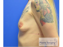 Breast Augmentation