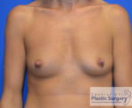 Breast Augmentation