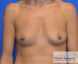 Breast Augmentation