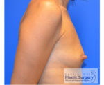 Breast Augmentation