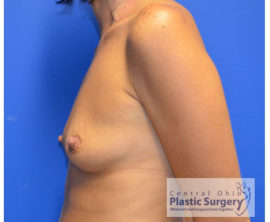 Breast Augmentation