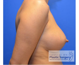 Breast Augmentation