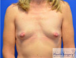 Breast Augmentation