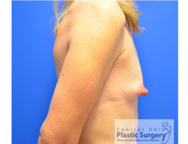 Breast Augmentation