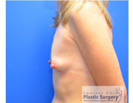 Breast Augmentation