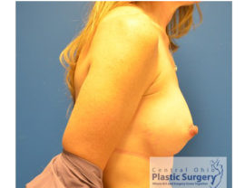 Breast Augmentation