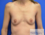 Breast Augmentation