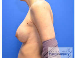 Breast Augmentation