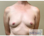 Breast Augmentation