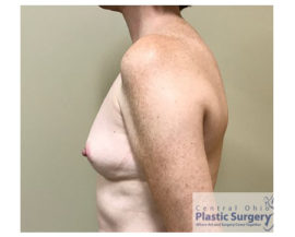 Breast Augmentation