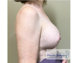 Breast Augmentation