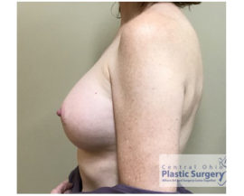 Breast Augmentation