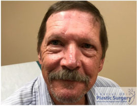 Skin Cancer Reconstruction