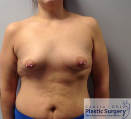 Breast Augmentation