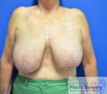 Breast Reduction/Breast Lift