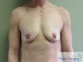 Breast Augmentation