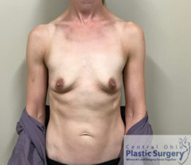 Breast Augmentation