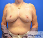 Breast Reduction/Breast Lift