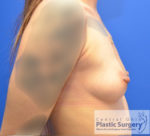 Breast Augmentation