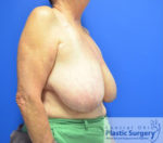 Breast Reduction/Breast Lift
