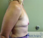 Breast Augmentation