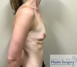 Breast Augmentation