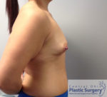 Breast Augmentation