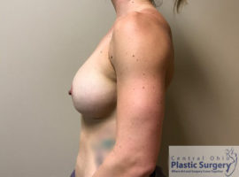 Breast Augmentation