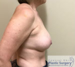 Breast Augmentation