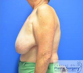Breast Reduction/Breast Lift