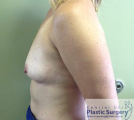 Breast Augmentation