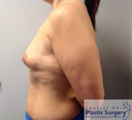 Breast Augmentation