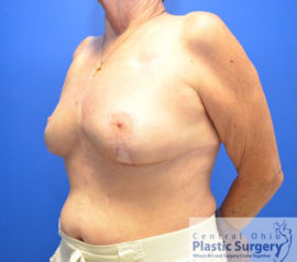 Breast Reduction/Breast Lift