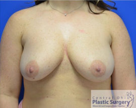 Breast Augmentation