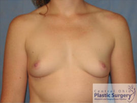 Breast Augmentation