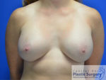 Breast Augmentation