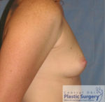 Breast Augmentation