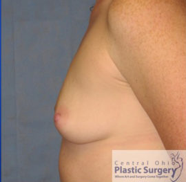 Breast Augmentation