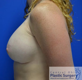 Breast Augmentation