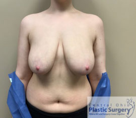 Breast Reduction/Breast Lift