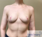 Breast Reduction/Breast Lift